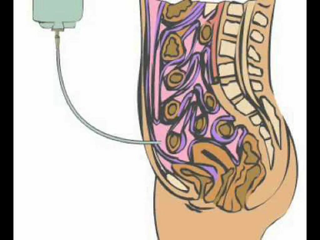 Перитонеальный катетер для диализа. Перитонеальный диализ брюшина. Перитониальный диализ. Методика перитонеального диализа.