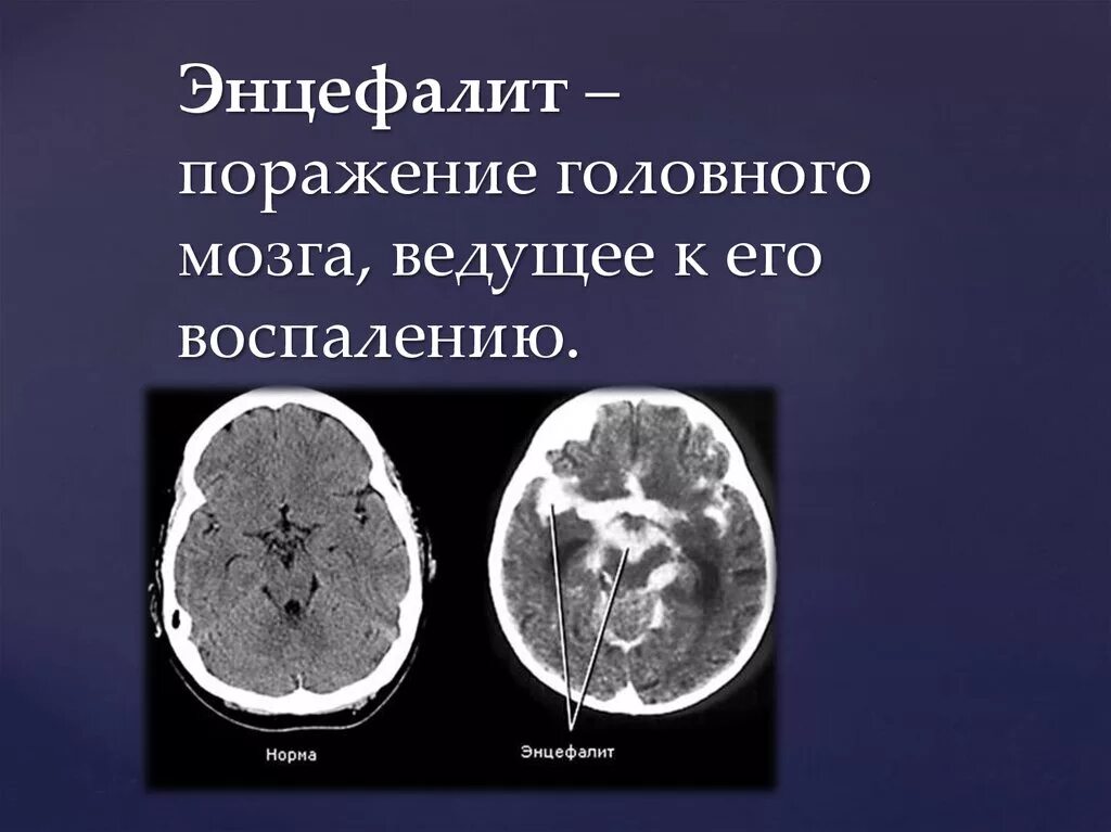 Поражение головного мозга последствия. Энцефалит головного мозга. Цифолит. Воспалительные поражения головного мозга.