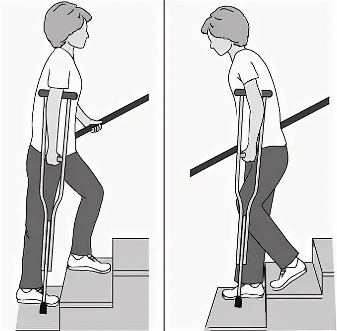Как подниматься по лестнице после эндопротезирования. Ходьба на костылях. Правильная регулировка костылей. Ходьба на костылях после эндопротезирования коленного сустава. Костыль с опорой на колено.