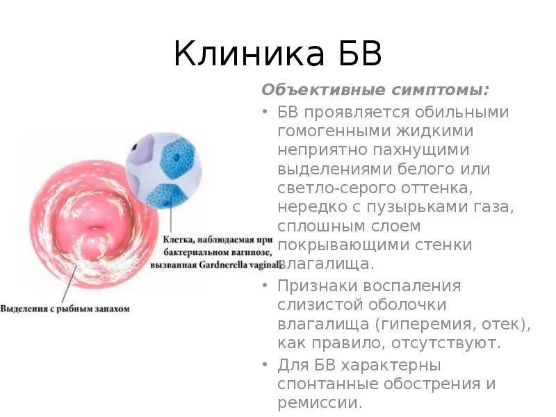 Запах рыбы у женщины лечить. Выделения из влагалища с запахом. выделения при бактериальном вагинозе. бактериальный вагиноз клиника.