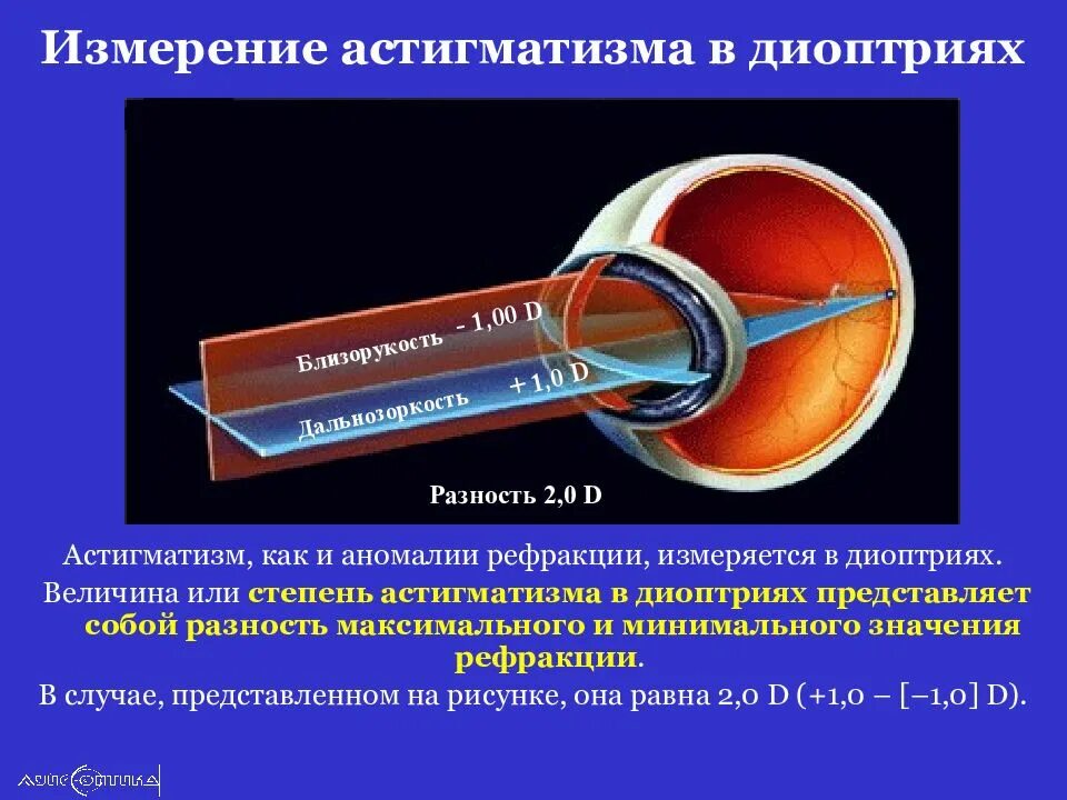 Астигматизм 1 5 диоптрия. Астигматизм 2.5 диоптрии. Разница рефракции астигматизм. Астигматизм -4.