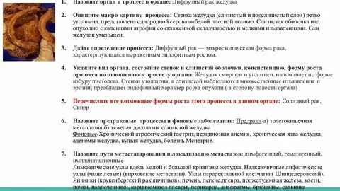 Метастазы в печени при раке желудка
