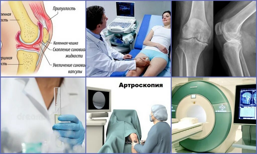 Собирается жидкость в суставах. Причина накопления жидкости в коленном суставе. Откачать жидкость в коленном суставе. Откачивание суставной жидкости. Синовит коленного сустава.