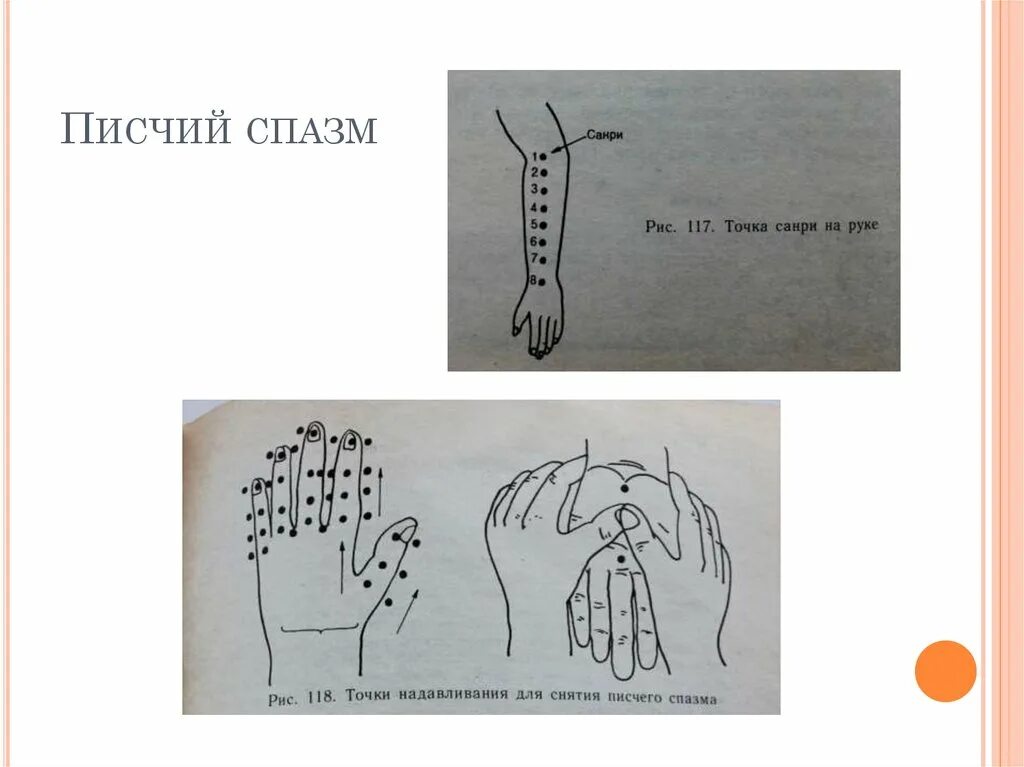 Писчий спазм. Писчий спазм неврология. писчий спазм возникает у. писчий спазм самомассаж.
