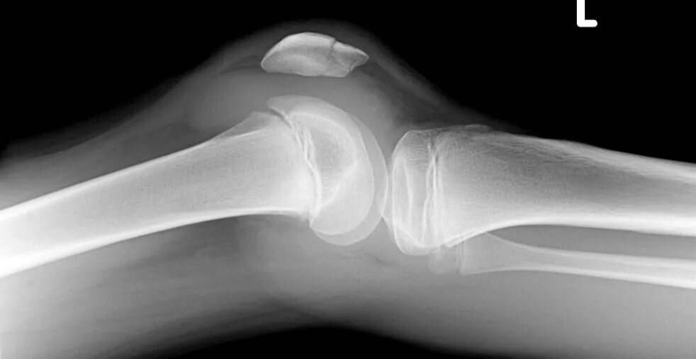 Перелом коленного сустава рентген. Перелом коленной чашечки рентген. Перелом лучевой кости рентген.