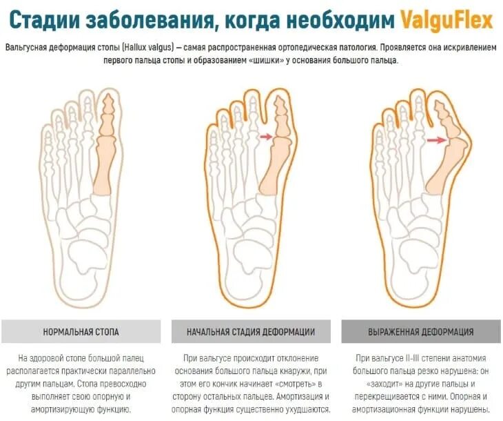 Вальгусная деформация стопы степени. Вальгусная деформация искривление стопы. Вальгусная деформация 1 пальца стопы (hallux valgus). Степень деформации халюкс вальгус. Вальгусная операция отзывы