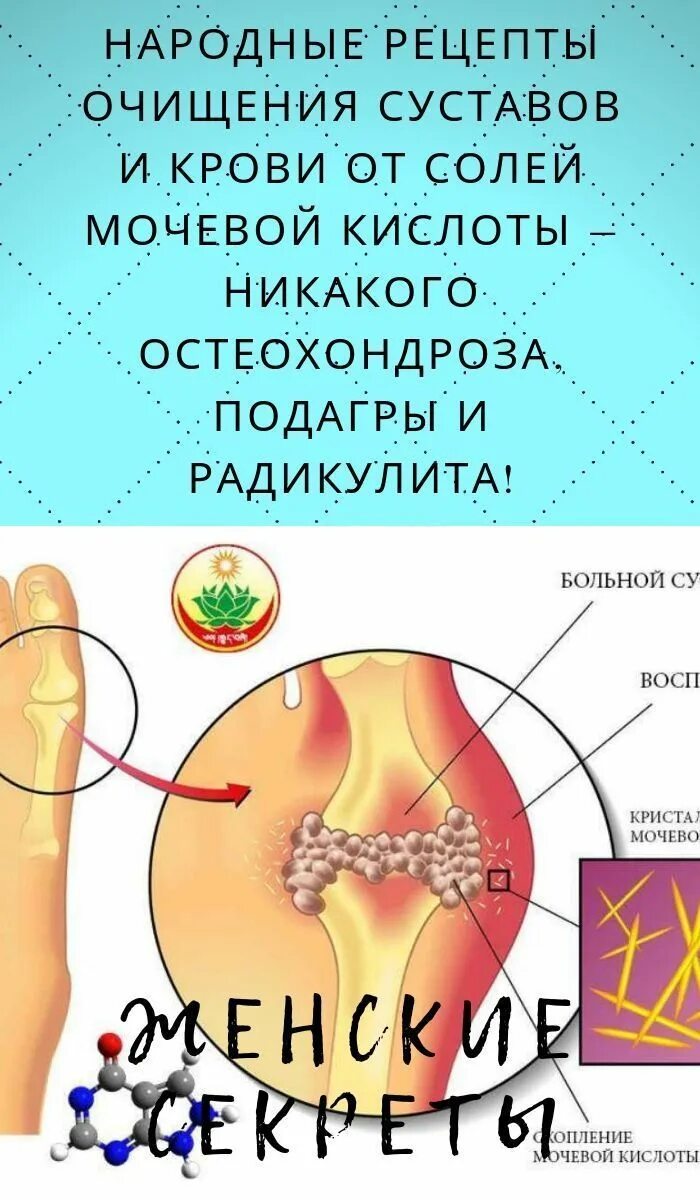 Как вывести мочевую кислоту народными средствами. Отложение солей мочевой кислоты. Отложение солей мочевой кислоты в суставах. Подагра отложение мочевой кислоты. Народные средства от мочевой кислоты.