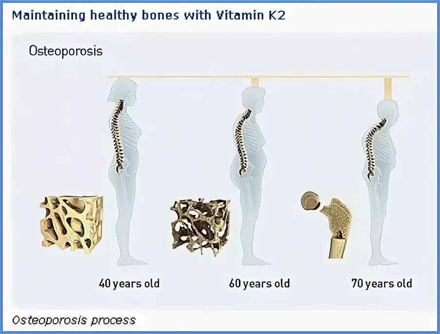 Vitamin k 2 Osteoporosis. Матрикс кости. Healthy Bones. Nutrition for Osteoporosis.