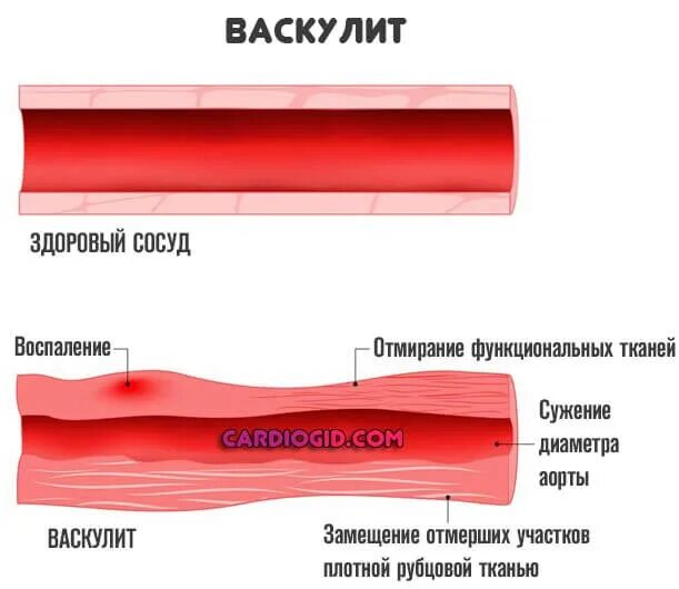 Васкулит с поражением сосудов крупного калибра. Геморрагический васкулит кожный. Васкулит мелких сосудов. Лейкоцитокластический васкулит. Васкулопатия это