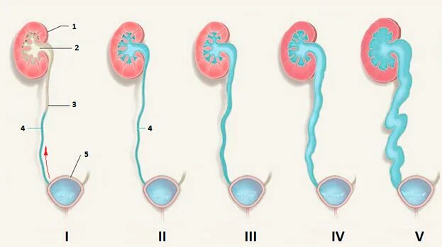 Пузырно-мочеточниковый рефлюкс. Пузырно-мочеточниково-лоханочный рефлюкс. Пузырно-мочеточниковый рефлюкс степени. Пузырно-мочеточниковый рефлюкс МЦУГ. Рефлюкс мочеточника