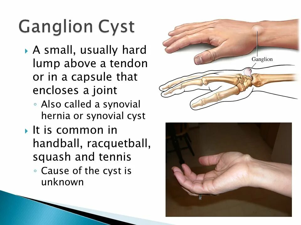 Ганглион кистевого сустава.