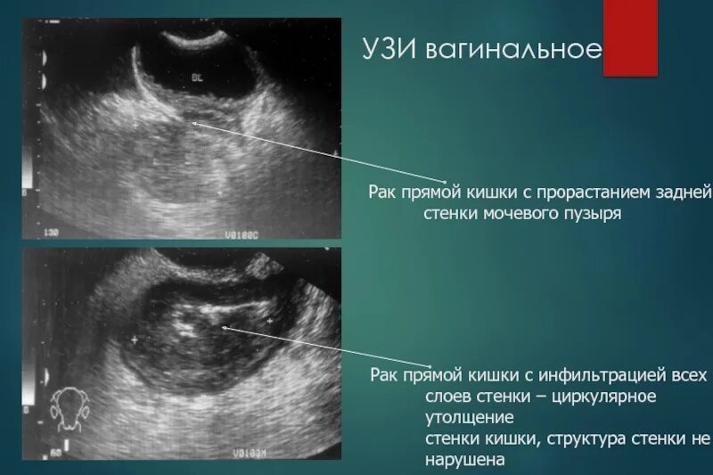 Утолщение стенок сигмовидной кишки на УЗИ. Утолщение стенок кишечника на УЗИ. Циркулярное утолщение стенок сигмовидной кишки что это. Можно на узи увидеть рак шейки матки