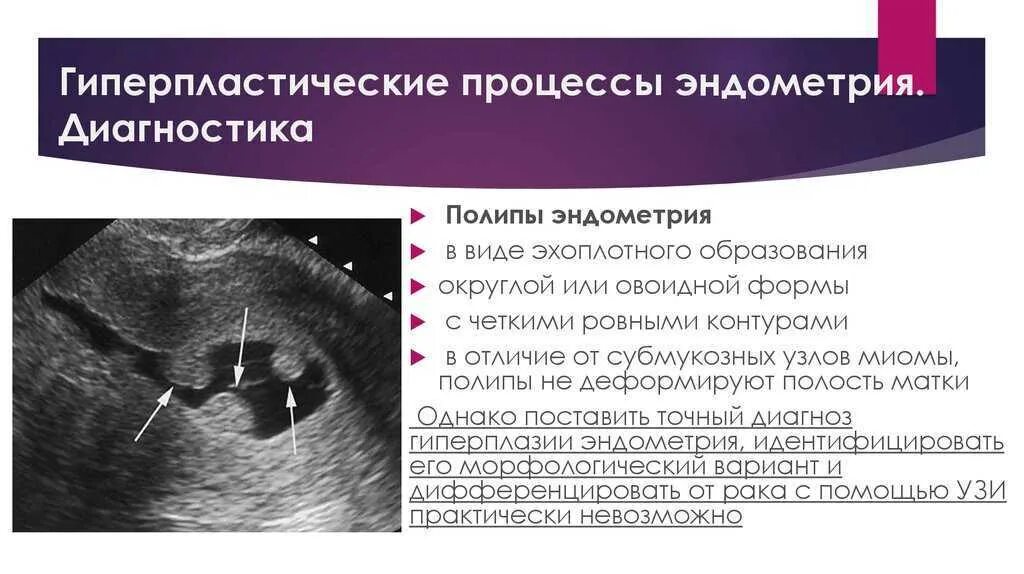Изменение эндометрия матки. Атипическая гиперплазия эндометрия узи. атипическая гиперплазия эндометрия диагноз. гиперпластические процессы эндометрия узи.