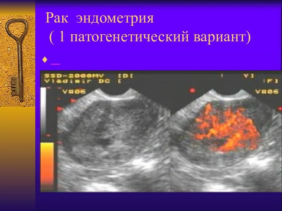 Гиперплазия эндометрия на УЗИ. Карцинома эндометрия на УЗИ.