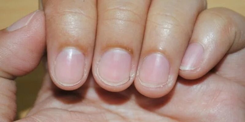 ногти стали волнистыми