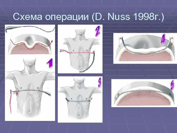 Как исправить грудную клетку. Коррекция деформации грудной клетки операция. Воронкообразная деформация грудины операция. Воронкообразная грудная клетка операция. Исправление воронкообразной грудной клетки.