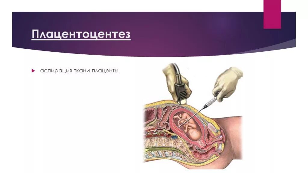 Плацентоцентез