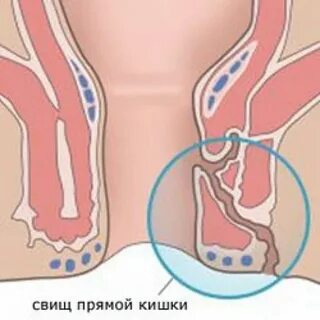 Свищ операция сколько длится