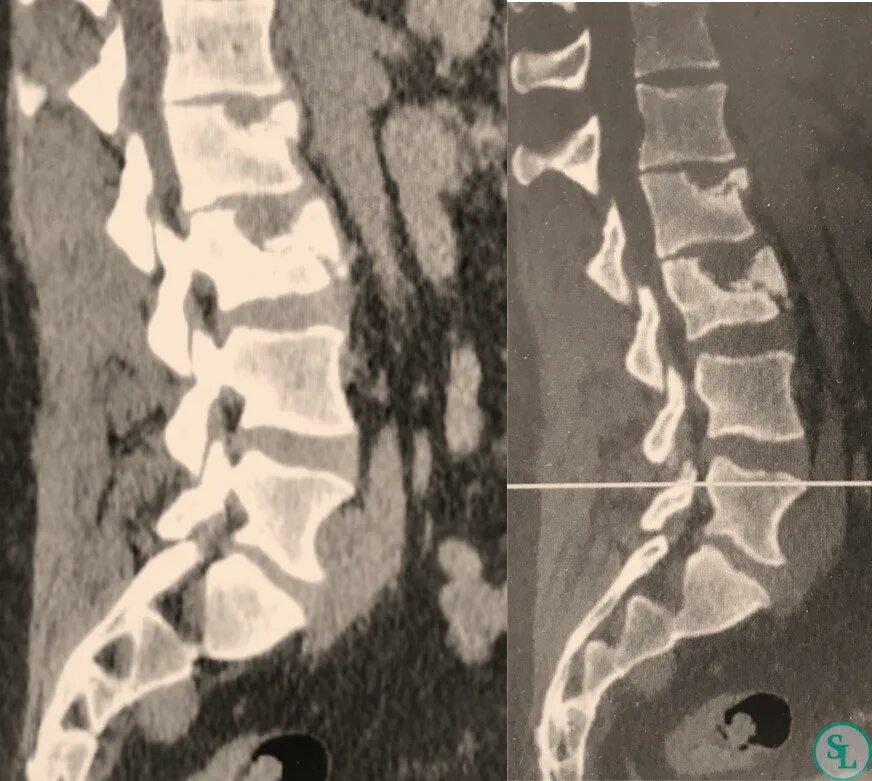 Компрессионные переломы l2,l3,l4. Компрессионный перелом l1 l2 позвонков. Компрессионный перелом l3 позвонка. Компрессионный перелом l2 позвонка. Компрессионный перелом тела 1 1
