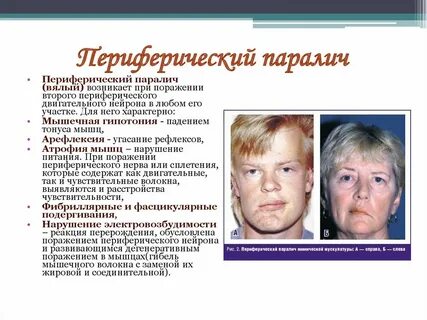 Парез мускулатуры