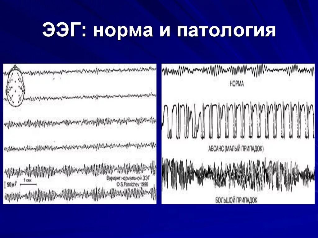 Ээг характеристика. ЭЭГ волны патологические. Ритмы ЭЭГ В норме. ЭЭГ норма и патология. Энцефалограмма показатели.