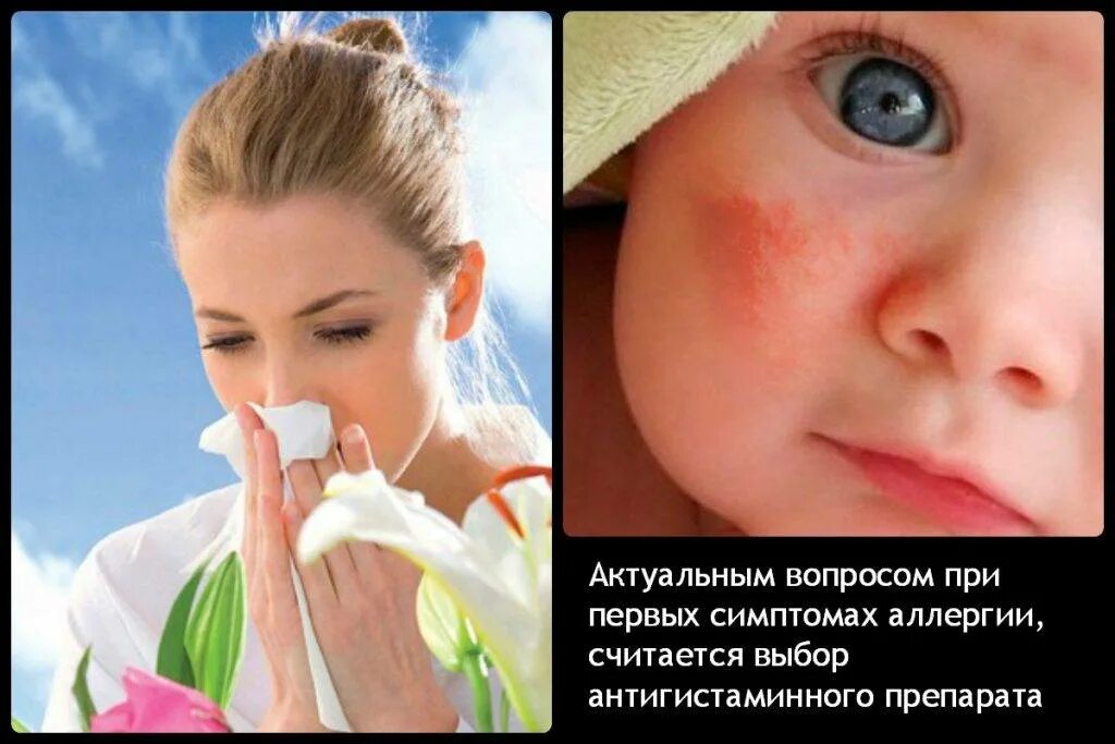 Аллергия на все как называется. Аллергия на все как называется