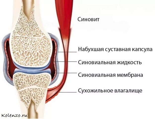 Синовит коленного сустава. Синовит синовиальная оболочка. Выпот коленного сустава что это. Внутрисуставные блокады коленного сустава. Синовиальный выпот в полости сустава.