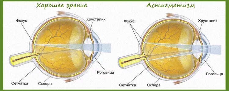 Миопия астигматизм глаз. Строение глаза миопия. Близорукость строение глаза. Структура глаза при близорукости. Анатомия глаза при близорукости.