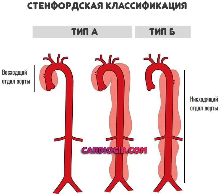 Расслоение аневризмы аорты классификация. Аневризма восходящего отдела аорты классификация. Расслаивающая аневризма аорты типы. ЭКГ при аневризме аорты грудного отдела. Аневризма показания к операции