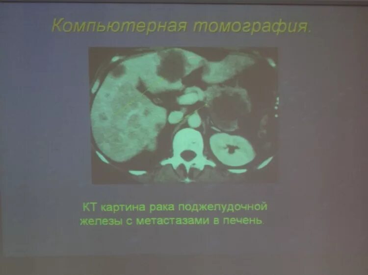 Поджелудочная железа отдаленные метастазы. Опухоль с метастазами поджелудочной железы. Новообразования поджелудочной железы с метастазированием в печень. Метастазы в печени на пэт кт. Протоковая аденокарцинома кт.