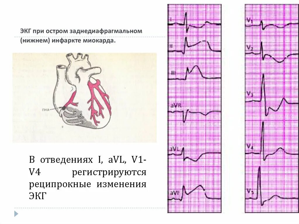 Мв на экг. Острый Нижний инфаркт миокарда на ЭКГ. Острый инфаркт миокарда нижней стенки на ЭКГ. Острый Нижний (заднедиафрагмальный) инфаркт миокарда ЭКГ. Острый трансмуральный инфаркт миокарда ЭКГ.