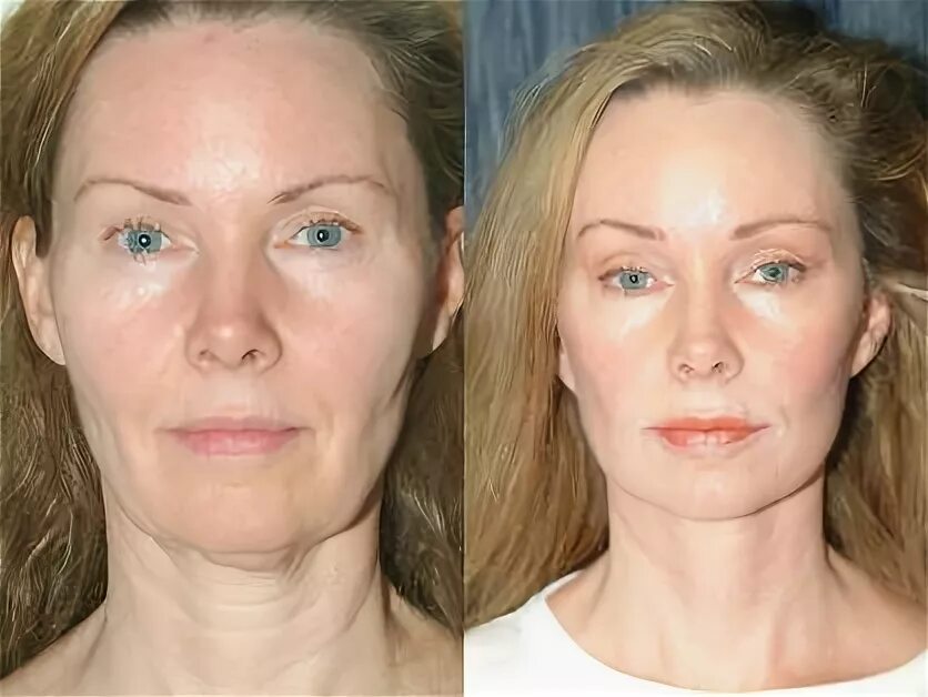 Морщины до после. Морщины до после. Сухое голодание и омоложение. Омоложение голоданием. Голодание омолаживает.