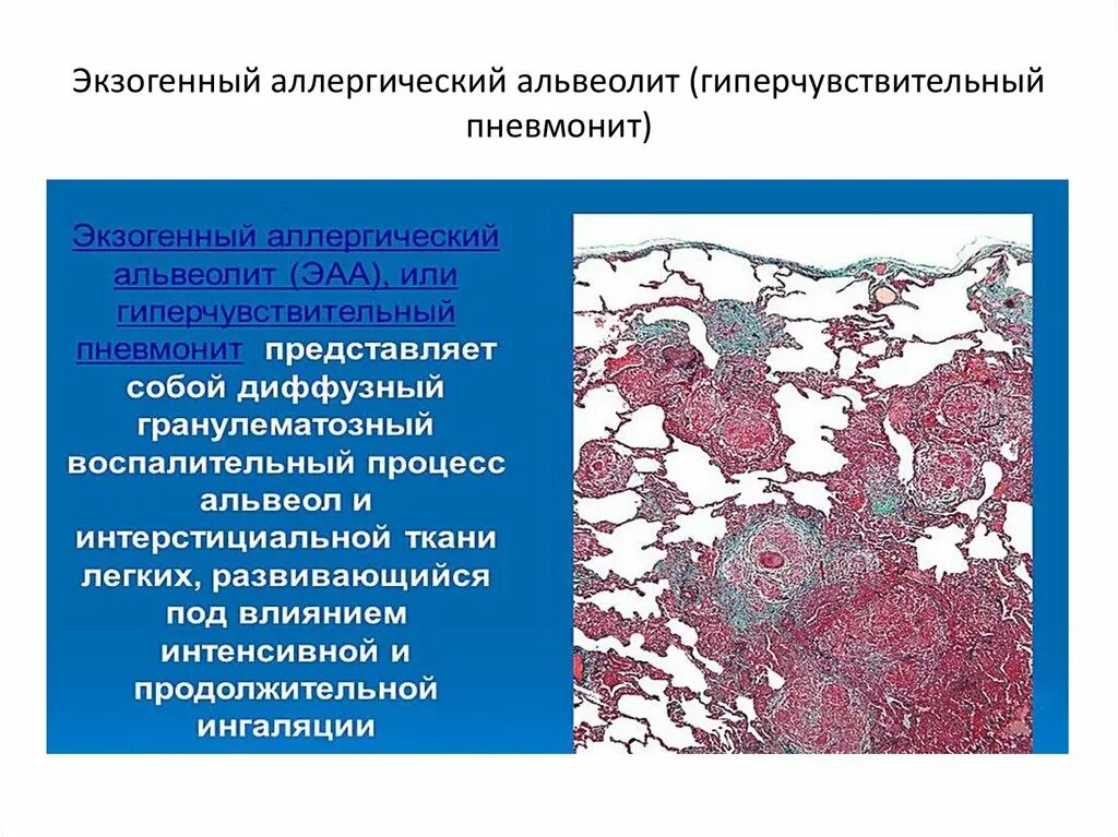 Экзогенный аллергический альвеолит. Экзогенный аллергический пневмонит. Гиперсенситивный пневмонит. Экзогенный токсико-аллергический альвеолит.