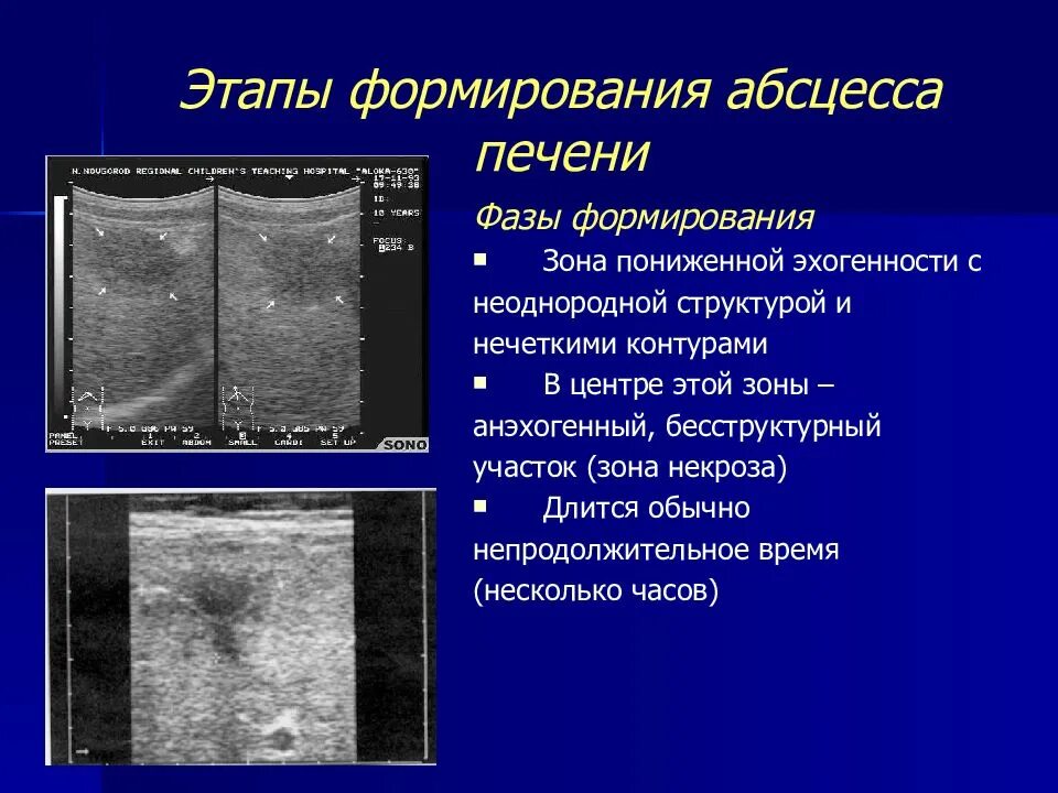 Пониженная эхогенность печени. Стадии формирования абсцесса. УЗИ признаки абсцесса печени.