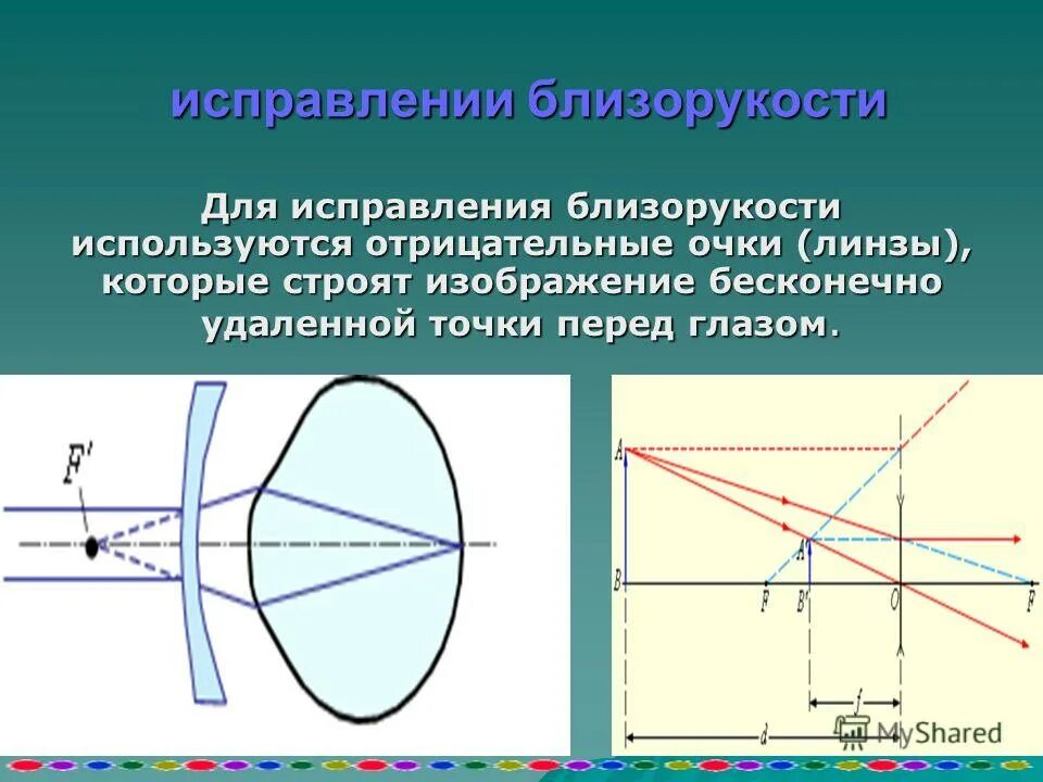 фоторефракционная кератэктомия (фрк). очки окулиста. способы коррекции миопии. способы исправления близорукости. миопия линзы для коррекции.