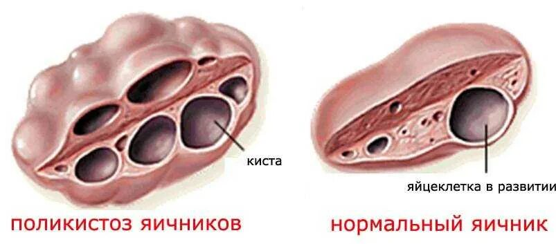 Поликистозные яичники лечение. Синдром поликистозных яичников (PCOS. Поликистозная морфология яичников.