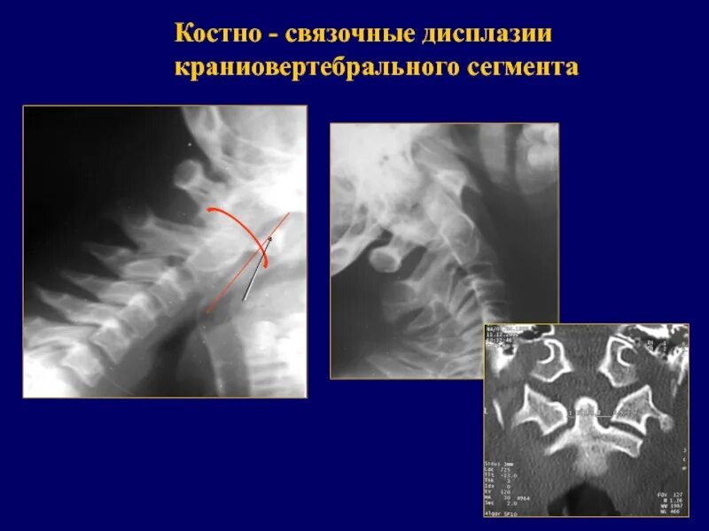 Аномалия перехода. Дисплазия краниовертебрального перехода. аномалии развития краниовертебрального перехода. рентген краниовертебральной области. дисплазия кранио-вертебрального перехода.