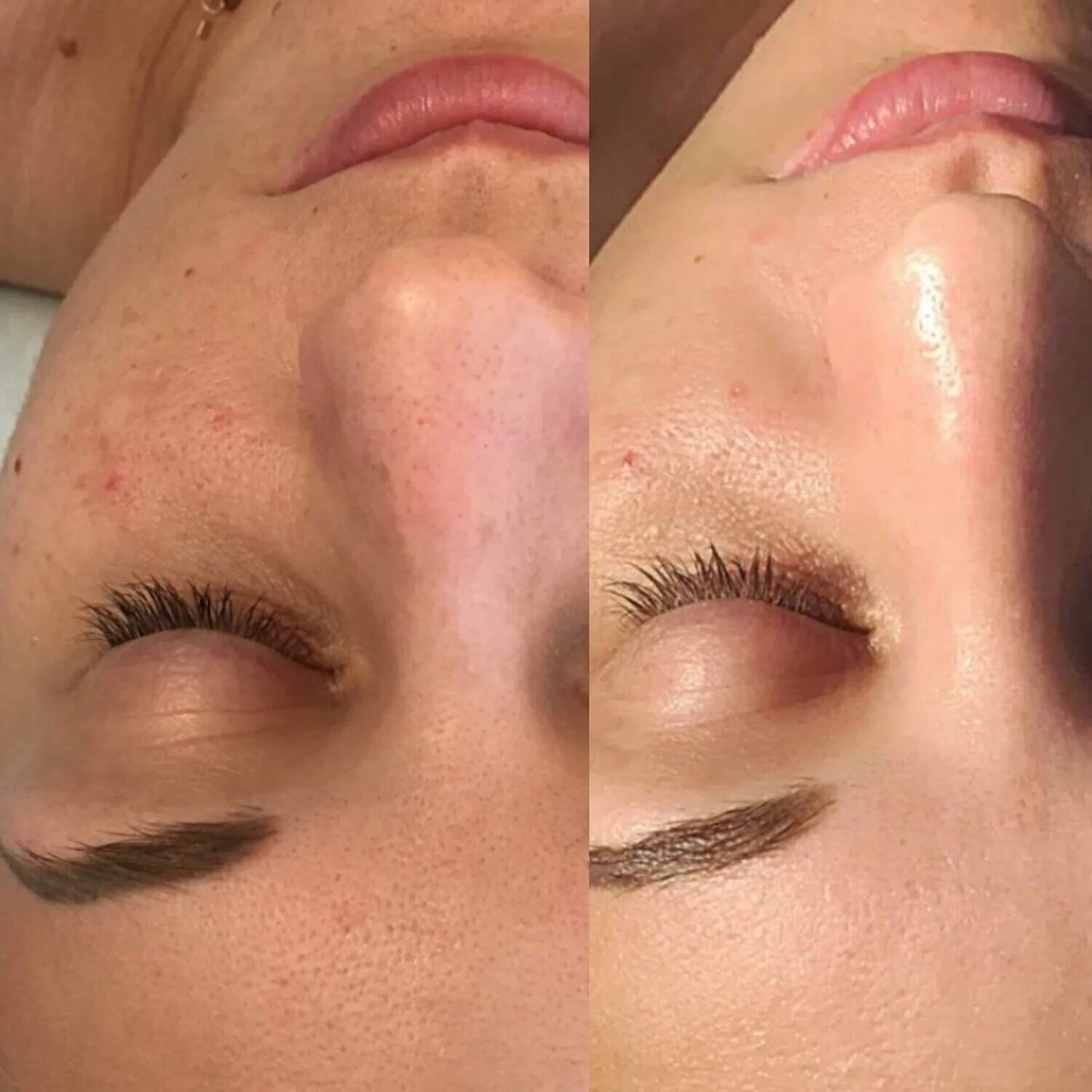 химический пилинг + альгинатная маска. пилинг. пилинг азелаиновый салициловый. химические пилинги для лица. химический пилинг jessner.