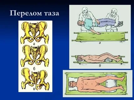 Перелом таза после