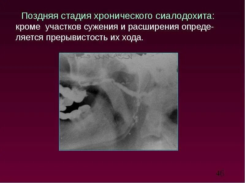 Сиалодохит. Сиалометрия слюнной железы. лучевая диагностика слюнных желез. сиалодохит рентгенодиагностика. сиалография и сиалометрия слюнных желез.