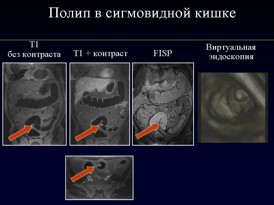 Липоматоз поджелудочной железы степени. Карцинома хвоста поджелудочной железы. Поджелудочная железа полипы лечение. Хронический панкреатит панкреонекроз. Поджелудочная железа полипы лечение.