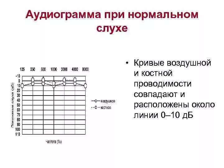 Аудиограмма слуха при нейросенсорной тугоухости 1 степени. Тональная пороговая аудиограмма норма. Аудиограмма здорового человека норма. Расшифровка аудиограммы слуха норма. Аудиограмма норма