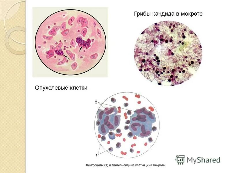 Грибы в мокроте