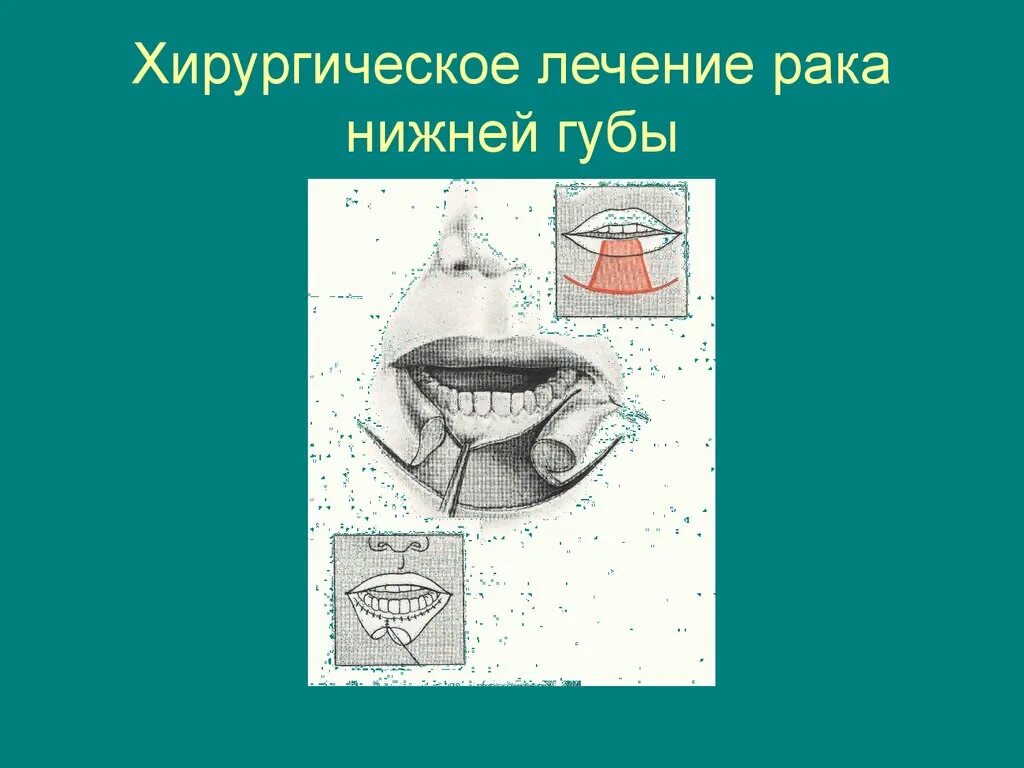 Рак губы признаки фото и лечение Диалог о вредных соблазнах" Мусина Зифа Шамиловна МОУ "Тарманская СОШ" скачать