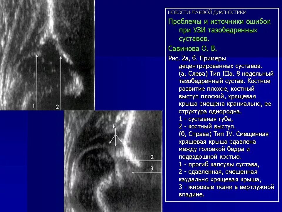 Делают ли узи тазобедренного сустава. Узи тазобедренного сустава у взрослых как проводится.