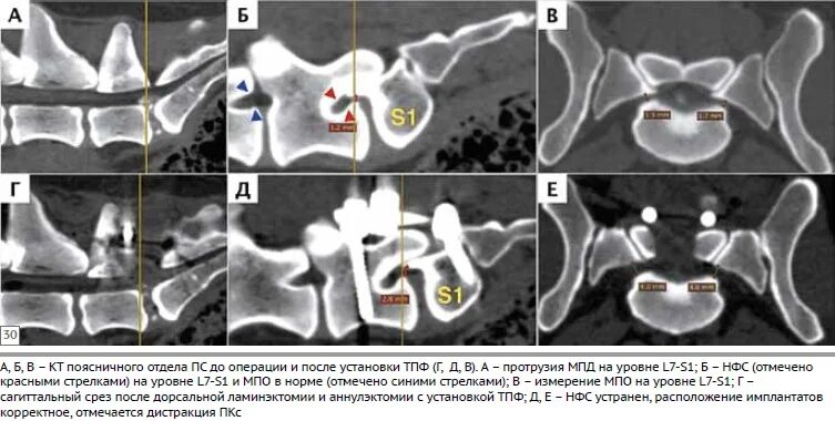 Дегенеративный люмбосакральный стеноз у собак. Люмбосакральный стеноз у собак. Транспедикулярная фиксация позвоночника у собак. Крестцовый стеноз