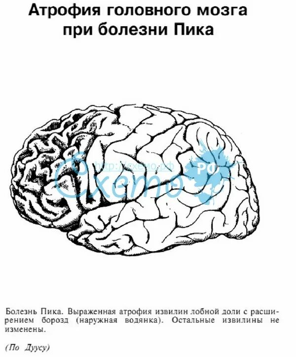 Тип пик. Заболевание ниманна пика. генная болезнь ниманна пика. болезнь ниманна пика патогенез.