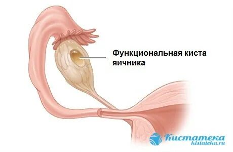 Функциональный яичник