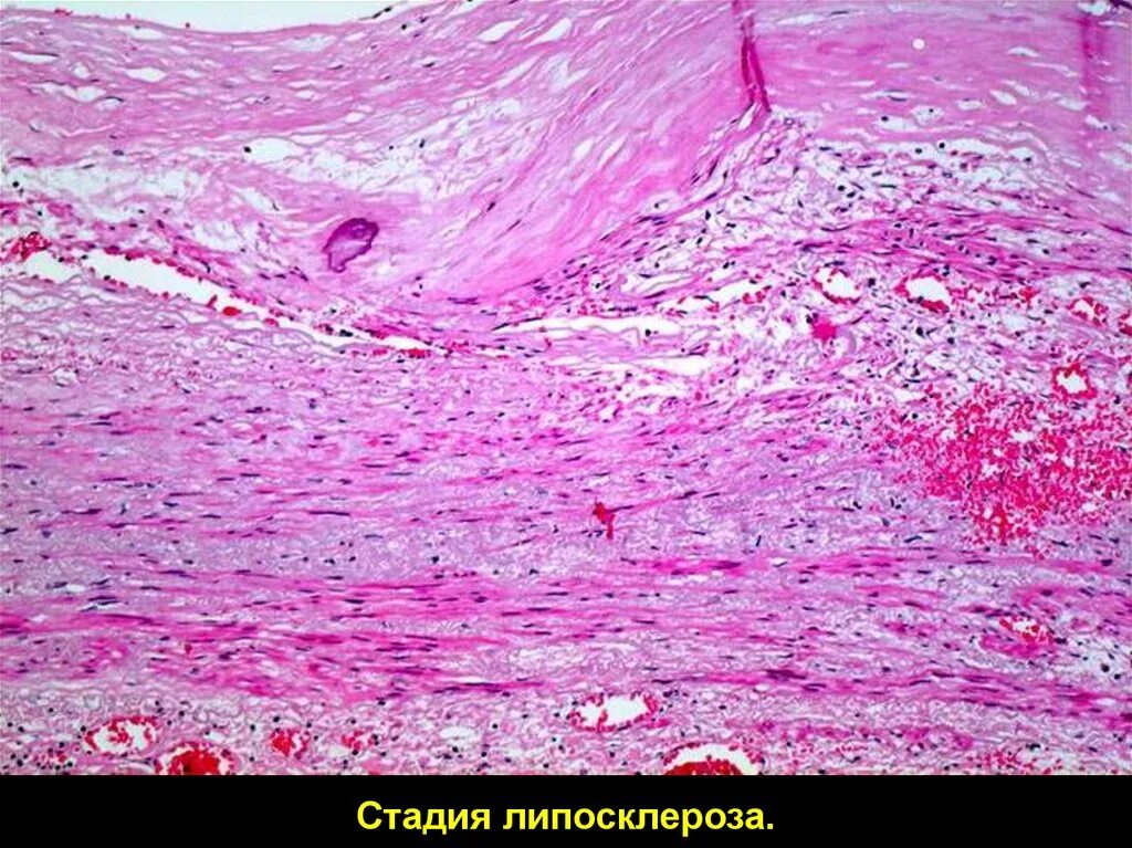 Атеросклероз аорты препарат. Липосклероз гистология. атеросклероз аорты стадия липоидоза микропрепарат. липоидоз сосудов гистология. липосклероз аорты микропрепарат.