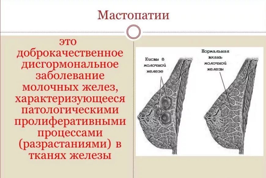 Фиброзная мастопатия молочной железы что это. Диффузионная фиброзно-кистозная мастопатия. Диффузная фиброзная мастопатия молочных желез маммография. Диффузная кистозная мастопатия - мастопатия. Диффузно фиброзные изменения молочных желез